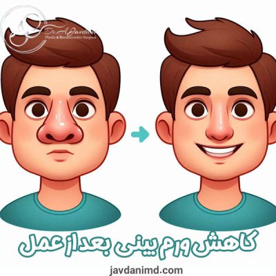 کاهش ورم بینی بعد از عمل - دکتر علی جاودانی