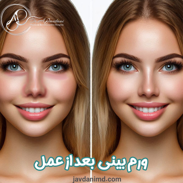 ورم بینی بعد از عمل - دکتر علی جاودانی