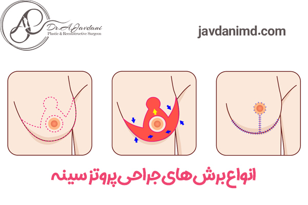 پروتز سینه - دکتر علی جاودانی