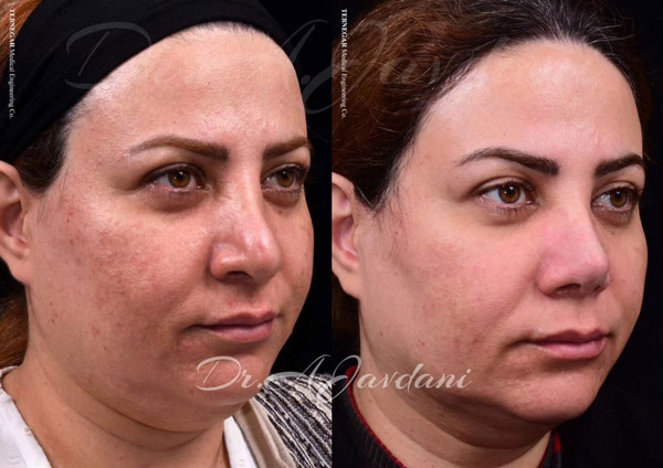 نمونه کار عمل بینی ترمیمی