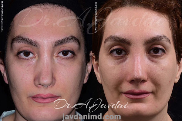 نمونه کارهای بهترین جراح بینی ترمیمی - دکتر علی جاودانی