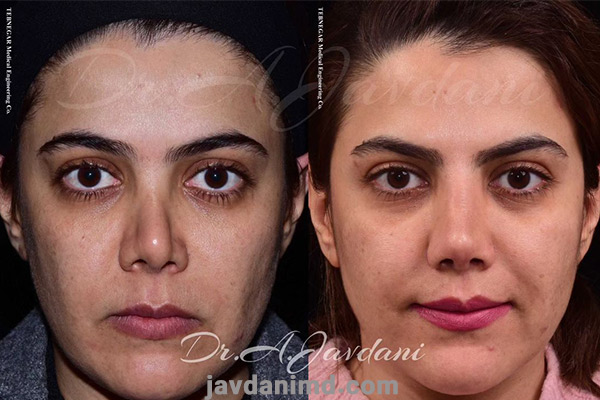 نمونه کارهای بهترین جراح بینی ترمیمی - دکتر علی جاودانی