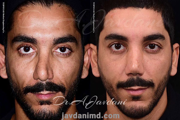 نمونه کارهای بهترین جراح بینی ترمیمی - دکتر علی جاودانی