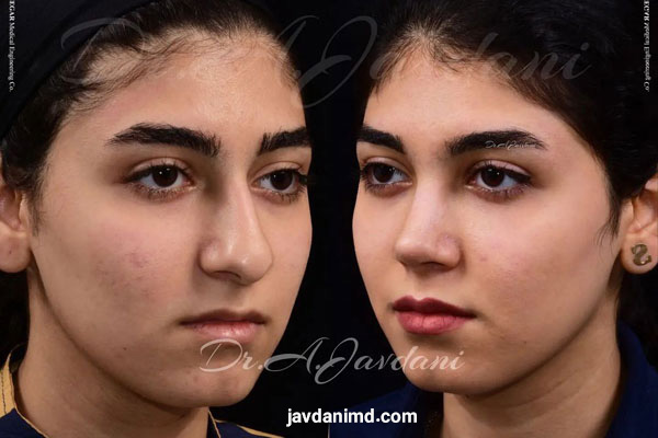 نمونه کار بهترین جراح بینی - دکتر جاودانی