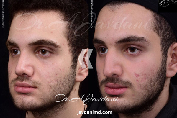 نمونه کار جراح بینی تهران - دکتر علی جاودانی