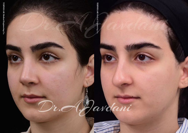 عمل بینی 2