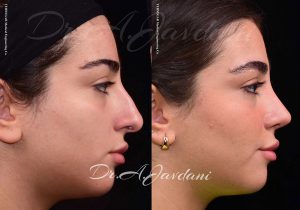 نمونه کار بهترین جراح بینی تهران - دکتر علی جاودانی