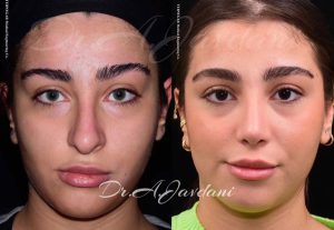 نمونه کار بهترین جراح بینی تهران - دکتر علی جاودانی
