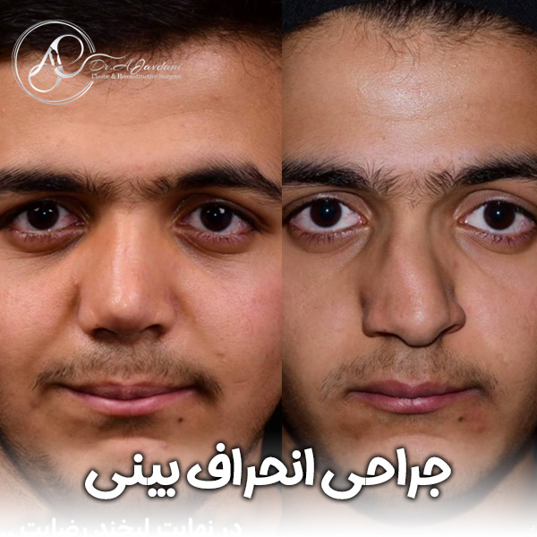 انحراف بینی + دکتر علی جاودانی