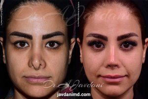 عکس های قبل و بعد از عمل بینی ترمیمی - دکتر جاودانی