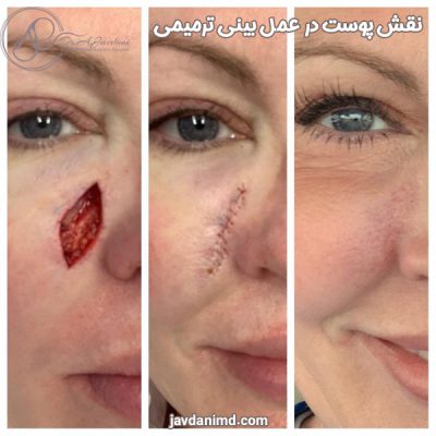 نقش پوست در عمل بینی ترمیمی - دکتر جاودانی