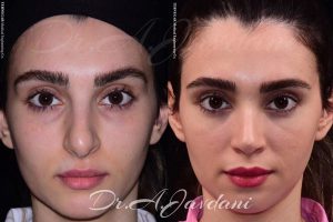 جراحی بینی استخوانی - دکتر جاودانی