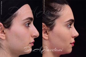 جراحی بینی استخوانی - دکتر جاودانی