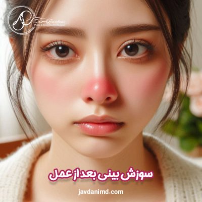 سوزش بینی بعد از عمل - دکتر علی جاودانی