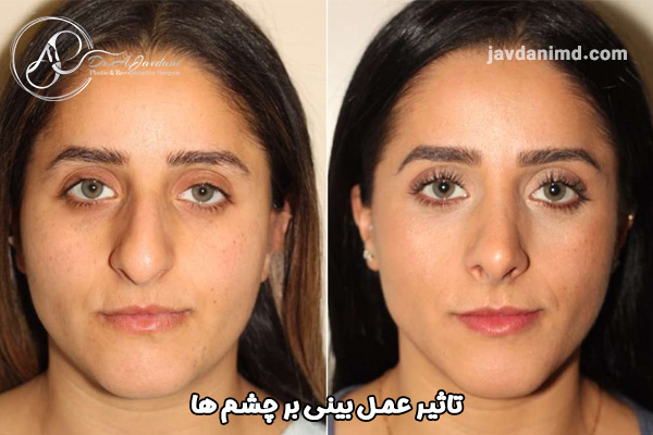 تاثیر عمل بینی بر چشم ها - دکتر علی جاودانی