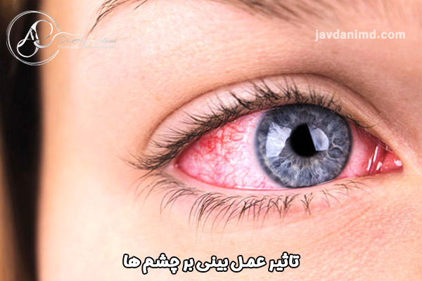 تاثیر جراحی بینی بر چشم ها - دکتر علی جاودانی