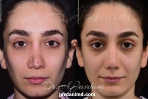 عکس های قبل و بعد از جراحی بینی ترمیمی - دکتر جاودانی