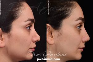 عکس های قبل و بعد از جراحی بینی ترمیمی - دکتر جاودانی