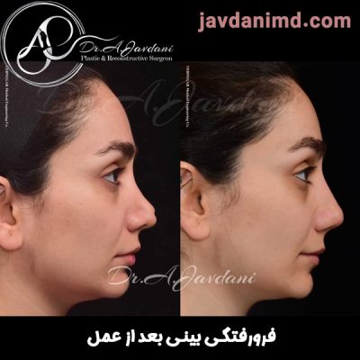 فرورفتگی بینی بعد از عمل - دکتر علی جاودانی