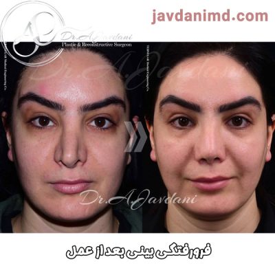 فرورفتگی بینی بعد از عمل - دکتر علی جاودانی