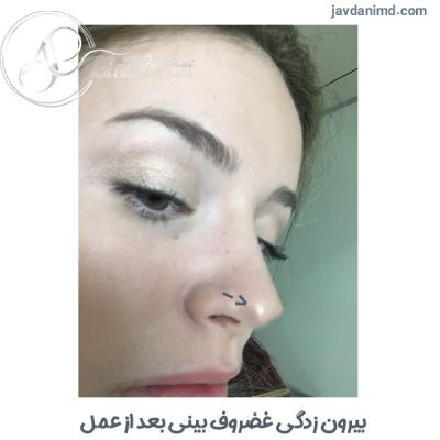 بیرون زدگی غضروف بینی بعد از عمل - دکتر جاودانی
