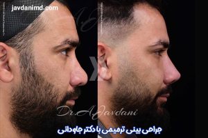 عکس قبل و بعد از عمل بینی ترمیمی - دکتر جاودانی