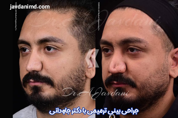 عکس قبل و بعد از جراحی بینی ترمیمی - دکتر جاودانی