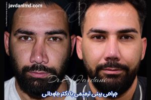 عکس قبل و بعد از عمل بینی ترمیمی - دکتر جاودانی