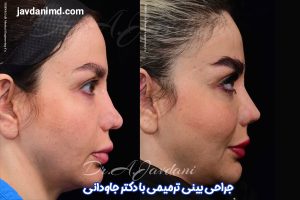 تصاویر قبل و بعد از جراحی بینی ترمیمی - دکتر جاودانی