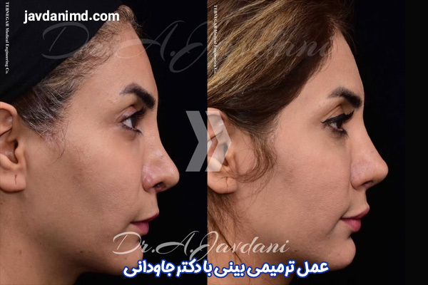 تصاویر قبل و بعد از عمل بینی ترمیمی - دکتر جاودانی