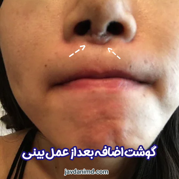 گوشت اضافه بعد از عمل بینی - دکتر جاودانی