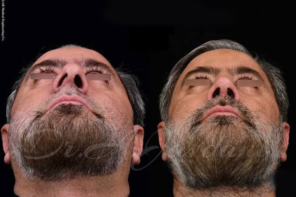 جراحی بینی در تهران | دکتر علی جاودانی
