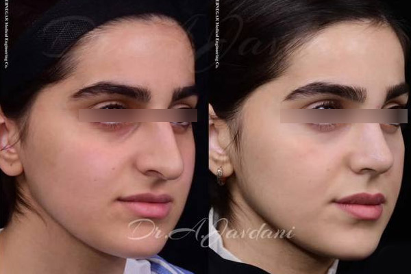 جراحی بینی در تهران | دکتر علی جاودانی