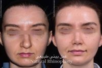 قبل و بعد جراحی زیبایی بینی | دکتر علی جاودانی
