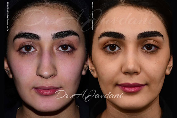 جراحی بینی نیمه فانتزی - دکتر جاودانی