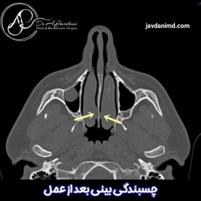 چسبندگی بینی بعد از عمل - دکتر جاودانی