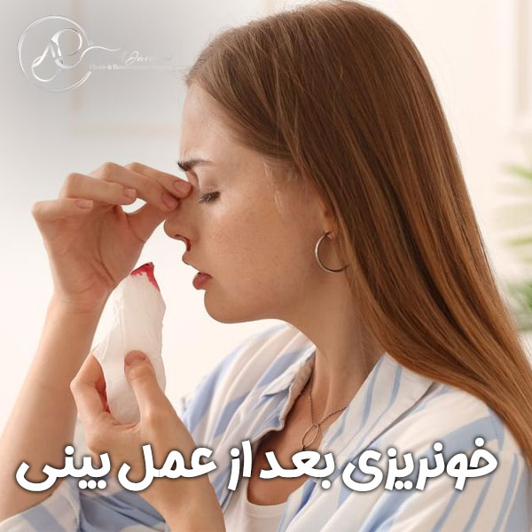 خونریزی بعد از عمل بینی + دکتر علی جاودانی