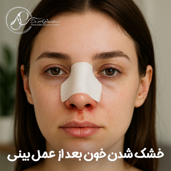 خشک شدن خون بعد از عمل بینی + دکتر علی جاودانی