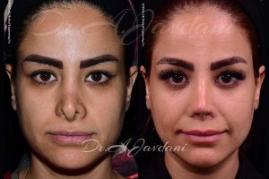عکس قبل و بعد رینوپلاستی ترمیمی + دکتر علی جاودانی 