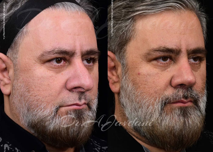 عمل بینی گوشتی در تهران + دکتر علی جاودانی