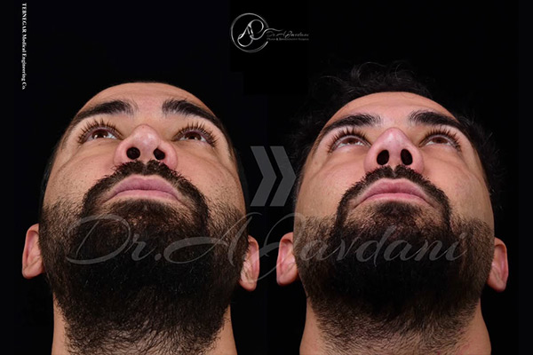 نمونه عمل بینی ترمیمی + دکتر علی جاودانی