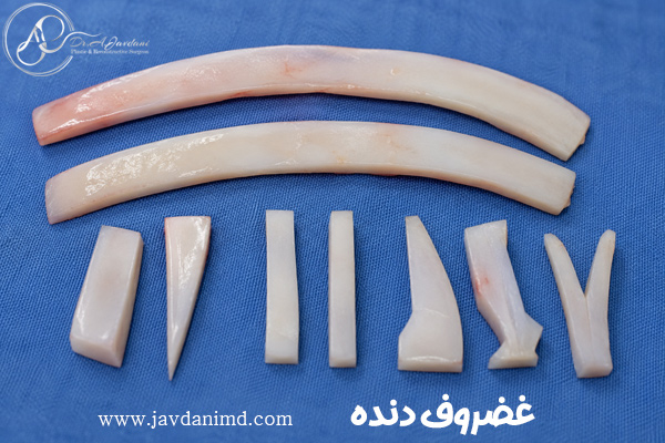 غضروف دنده + دکتر علی جاودانی