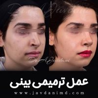 عمل ترمیمی بینی - دکتر جاودانی