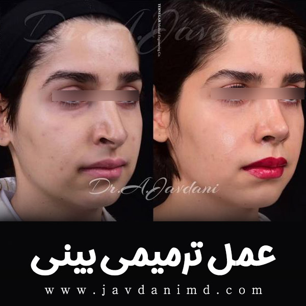 عمل ترمیمی بینی - دکتر جاودانی