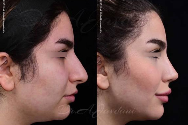 قبل و بعد جراحی زیبایی بینی | دکتر علی جاودانی