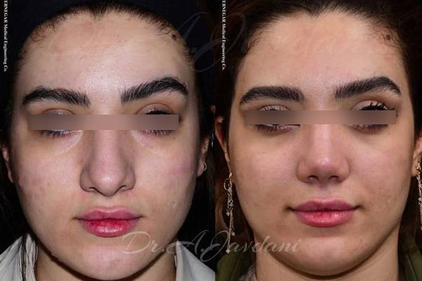قبل و بعد جراحی زیبایی بینی | دکتر علی جاودانی