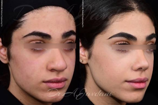 جراحی بینی در تهران ✔️ نمونه کارهای فوق العاده دکتر جاودانی