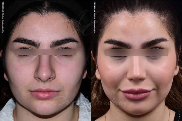 جراحی بینی در تهران ✔️ نمونه کارهای فوق العاده دکتر جاودانی